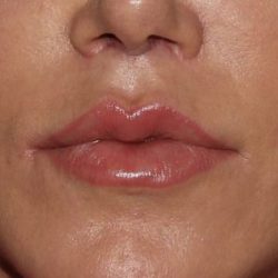 Lip Enhancements Before & After Patient #750