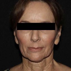 Deep Plane Restore Before & After Patient #791