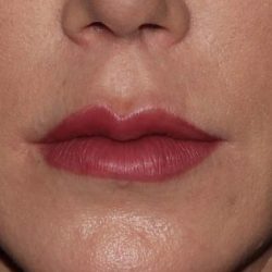 Lip Enhancements Before & After Patient #750