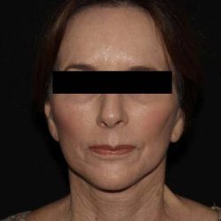 Deep Plane Restore Before & After Patient #791