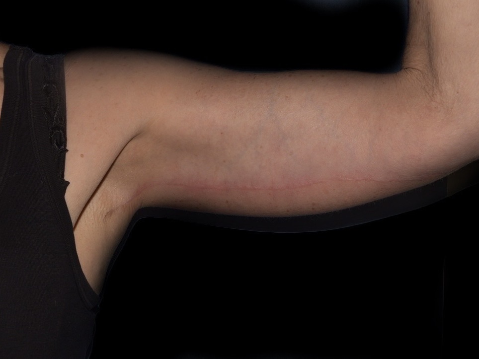 Arm Lift Before & After Patient #749