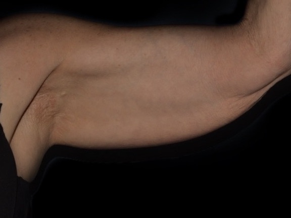 Arm Lift Before & After Patient #749