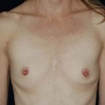 Breast Augmentation Before & After Patient #859