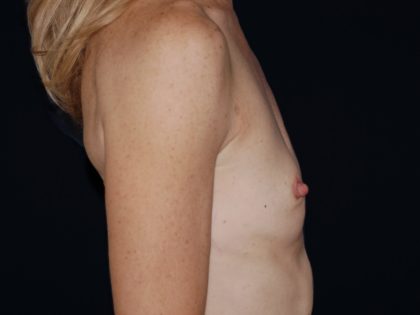 Breast Augmentation Before & After Patient #859
