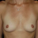 Breast Augmentation Before & After Patient #866