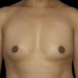 Breast Augmentation Before & After Patient #871