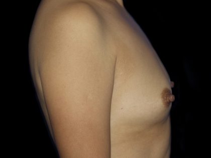 Breast Augmentation Before & After Patient #871