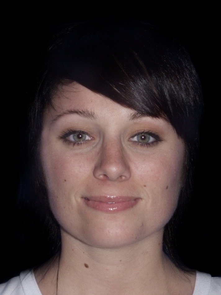 Rhinoplasty Before & After Patient #721