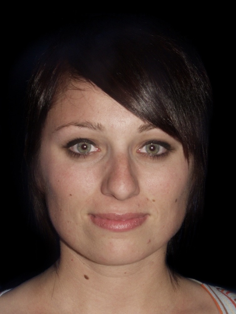 Rhinoplasty Before & After Patient #721
