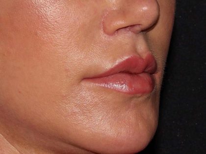 Lip Enhancements Before & After Patient #750
