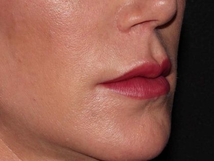 Lip Enhancements Before & After Patient #750
