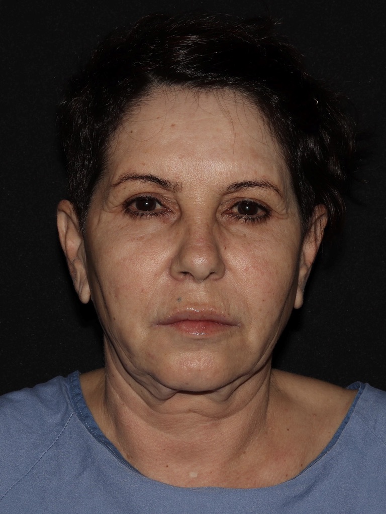 Deep Plane QuickLift Before & After Patient #836