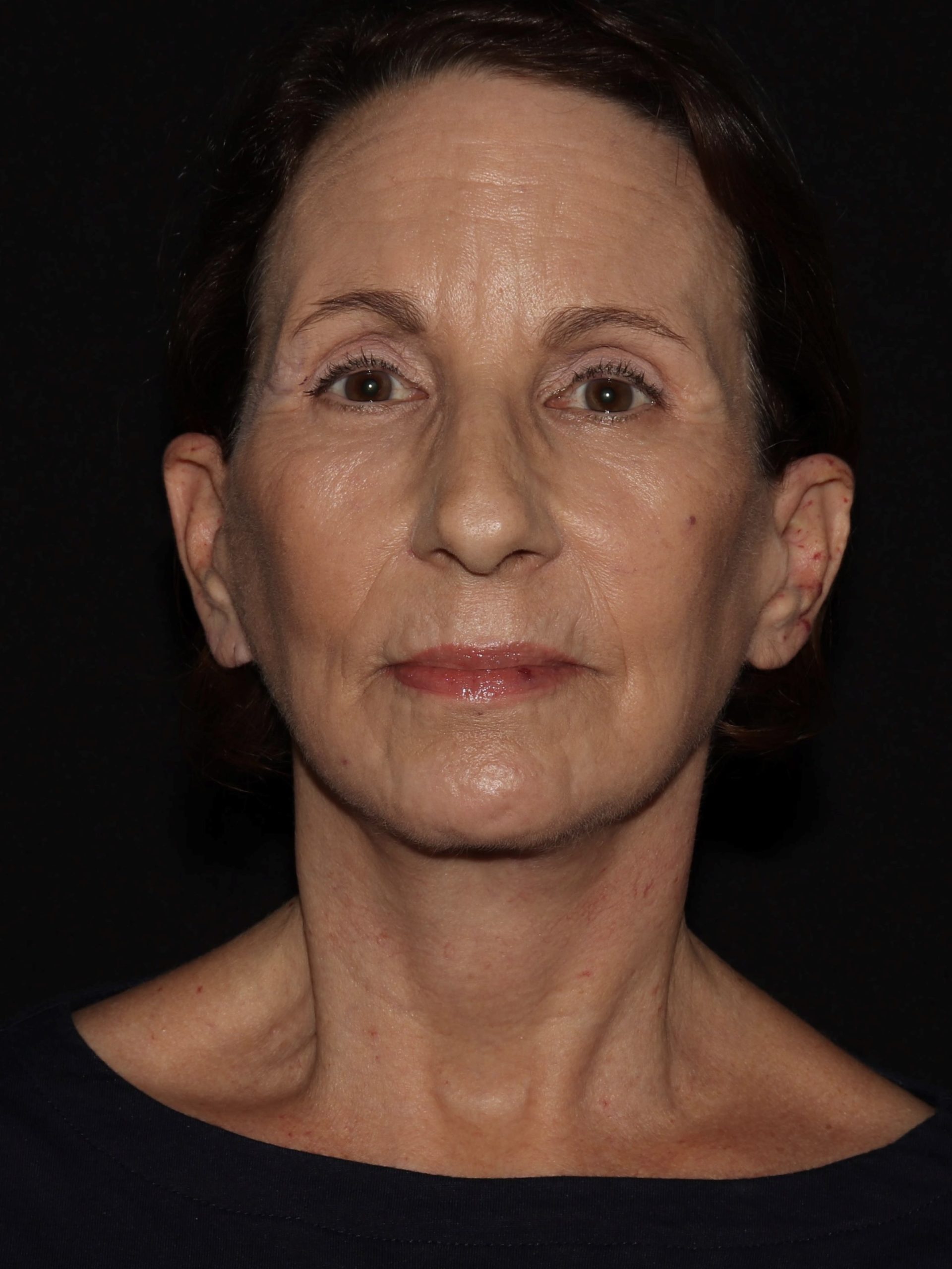 Deep Plane Restore Before & After Patient #829