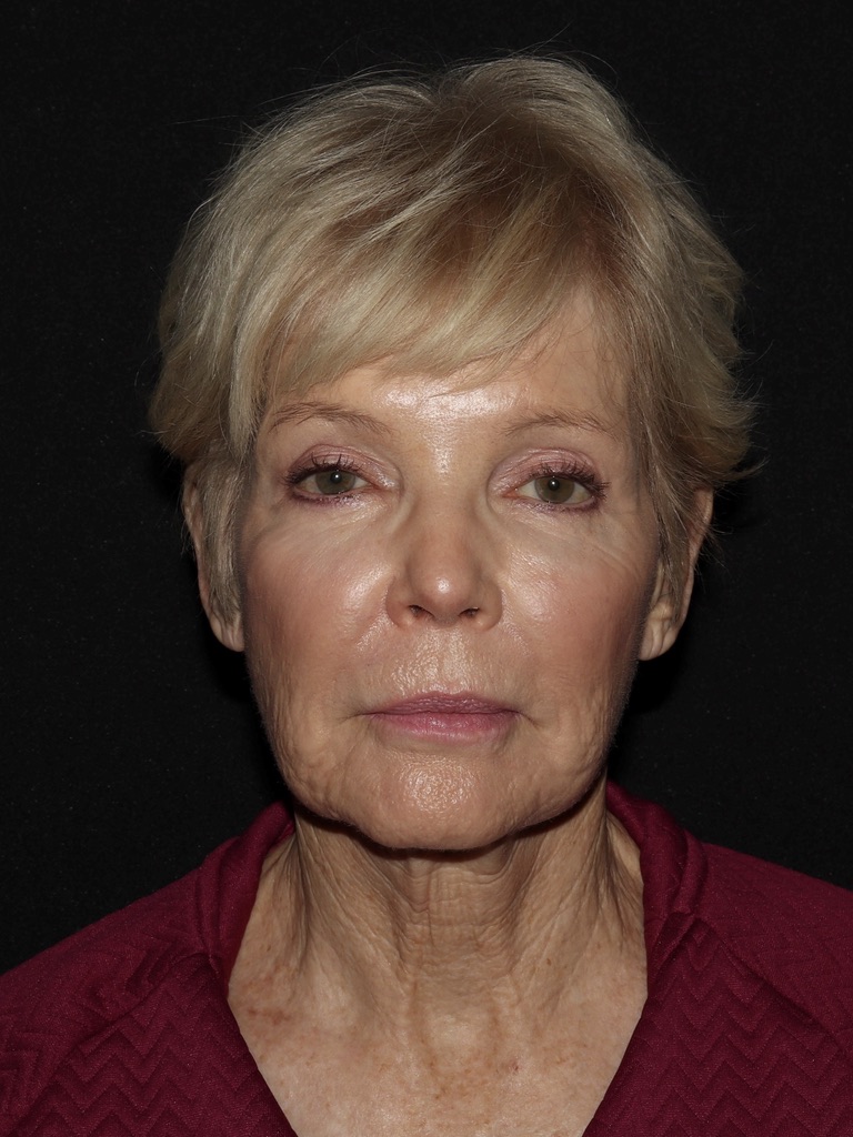 Deep Plane Restore Before & After Patient #822