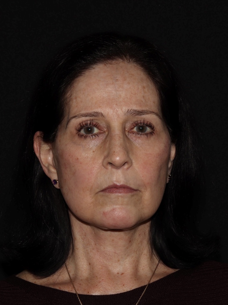 Deep Plane Restore Before & After Patient #815