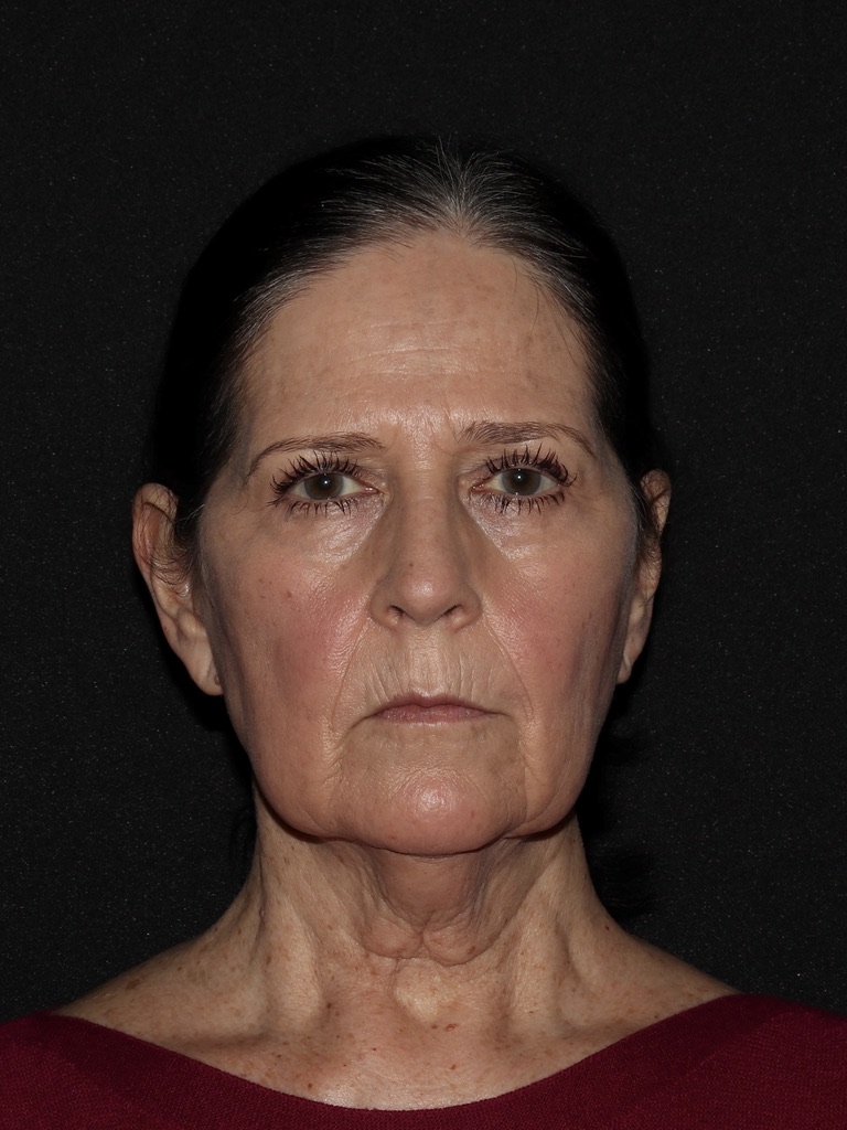 Deep Plane Restore Before & After Patient #815