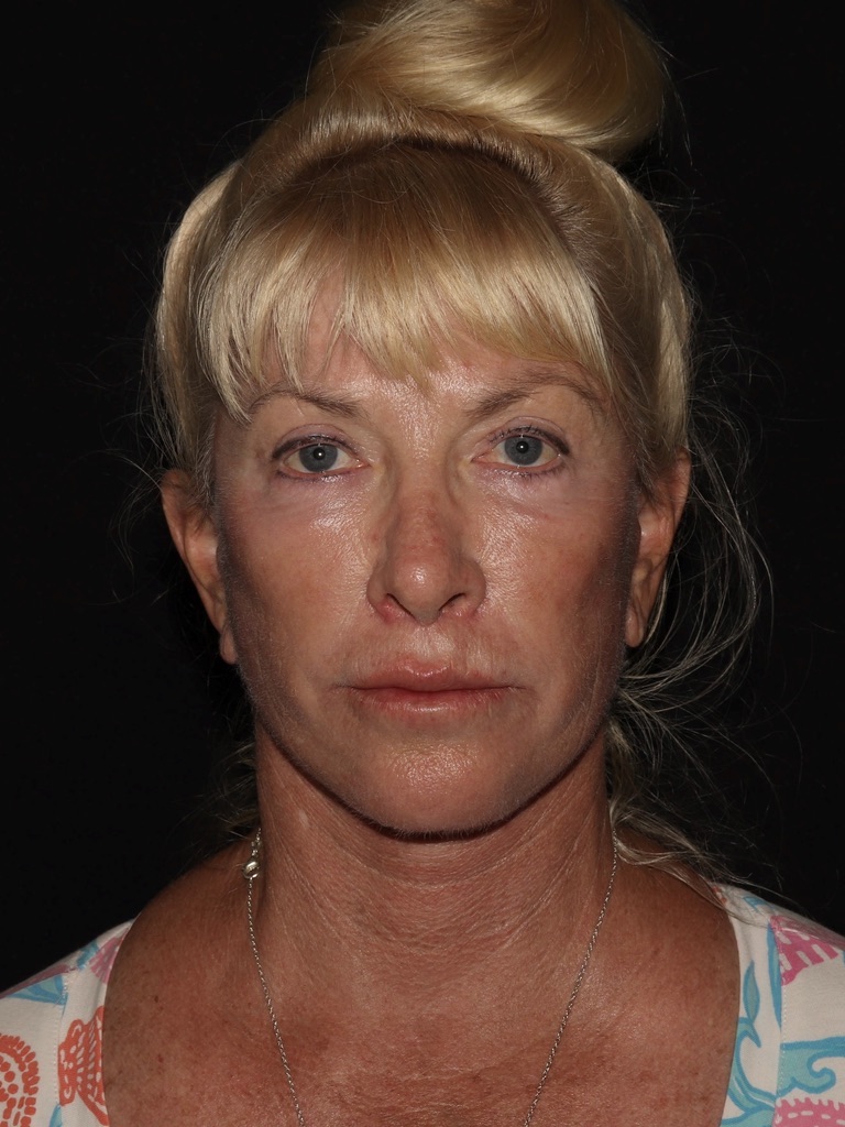 Deep Plane Restore Before & After Patient #808