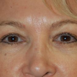 Eyelid Surgery Before & After Patient #1007