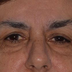 Eyelid Surgery Before & After Patient #1008