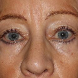 Eyelid Surgery Before & After Patient #1009