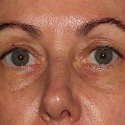Eyelid Surgery Before & After Patient #1010