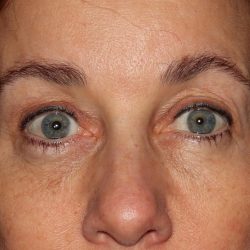 Eyelid Surgery Before & After Patient #1011