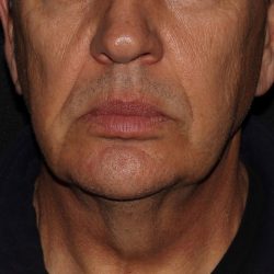 Deep Plane FaceLift Before & After Patient #1090