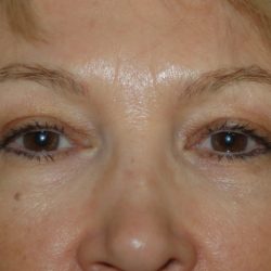 Eyelid Surgery Before & After Patient #1007