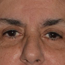 Eyelid Surgery Before & After Patient #1008