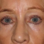 Eyelid Surgery Before & After Patient #1009