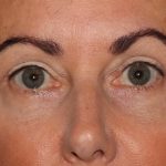 Eyelid Surgery Before & After Patient #1010