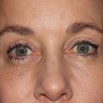Eyelid Surgery Before & After Patient #1011