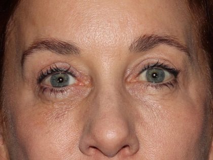 Eyelid Surgery Before & After Patient #1011