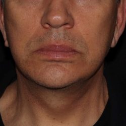 Deep Plane FaceLift Before & After Patient #1090