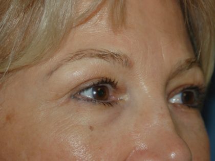Eyelid Surgery Before & After Patient #1007
