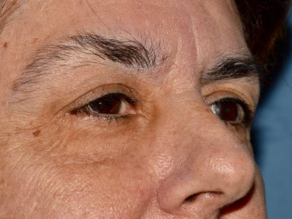 Eyelid Surgery Before & After Patient #1008