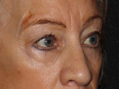 Eyelid Surgery Before & After Patient #1009