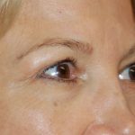 Eyelid Surgery Before & After Patient #1007