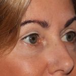 Eyelid Surgery Before & After Patient #1010