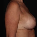 Breast Lift Before & After Patient #1169