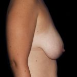 Breast Lift Before & After Patient #1176