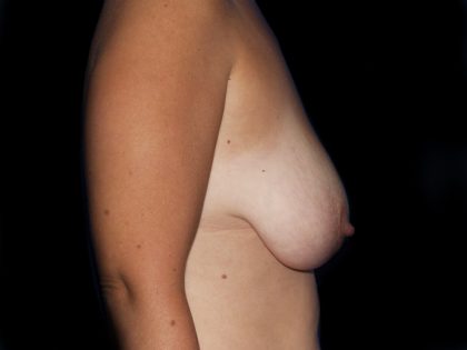 Breast Lift Before & After Patient #1176