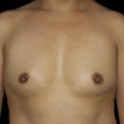 Breast Augmentation Before & After Patient #1002