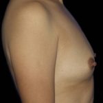 Breast Augmentation Before & After Patient #1002