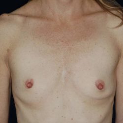 Breast Augmentation Before & After Patient #1018