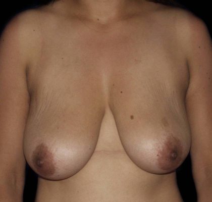 Breast Augmentation & Lift Before & After Patient #1025
