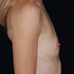 Breast Augmentation Before & After Patient #1018