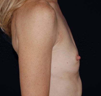 Breast Augmentation Before & After Patient #1018