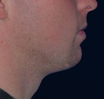 Chin Reshaping Before & After Patient #1050