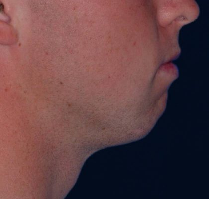 Chin Reshaping Before & After Patient #1050